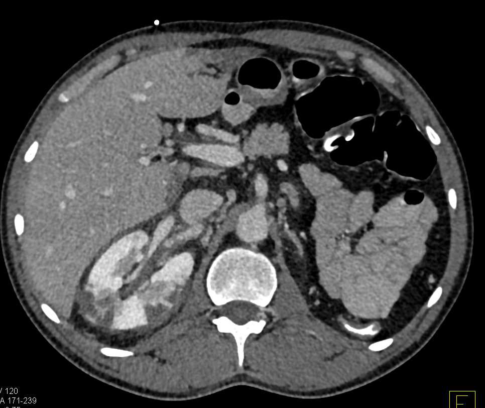 Multiple Emboli to the Kidneys and Mesenteric Vessels with Superior Mesenteric Artery (SMA) Thrombi - CTisus CT Scan