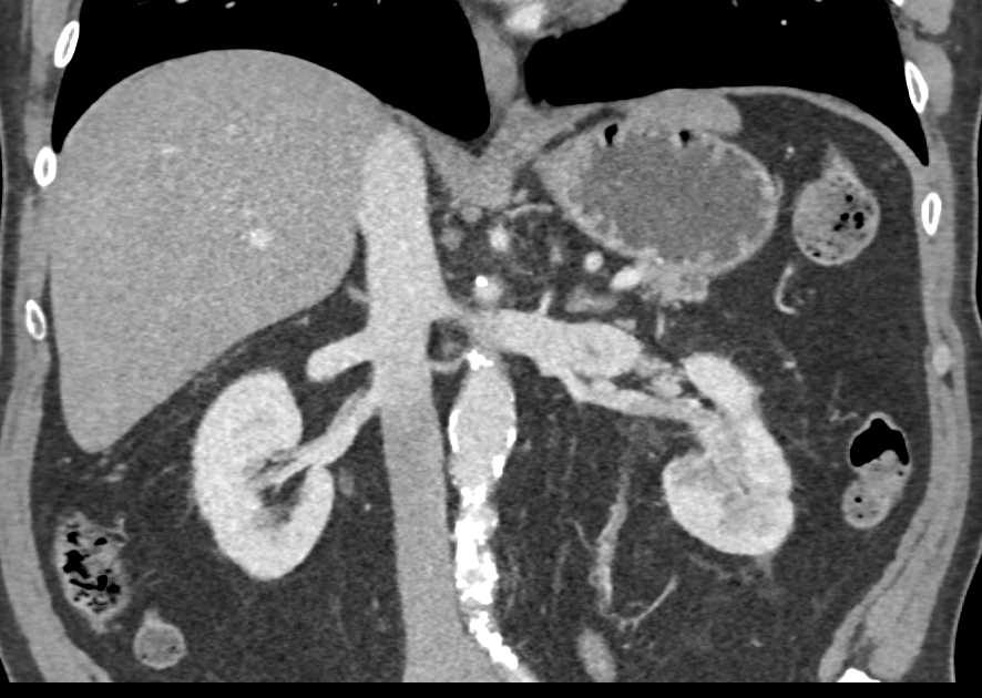 Arteriovenous (AV) Fistulae Left Renal Pelvis due to Tumor - CTisus CT Scan