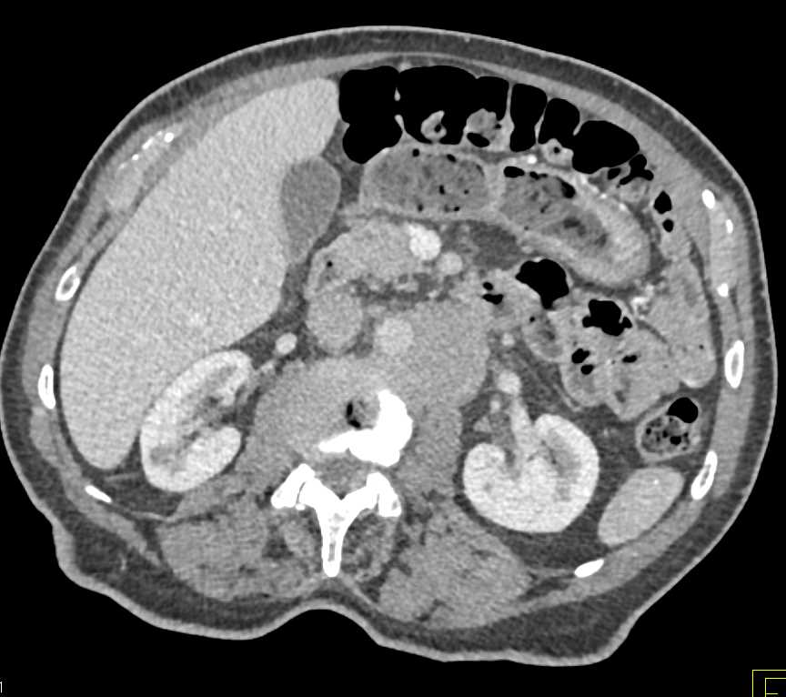 Tumor Encases the Aorta - CTisus CT Scan