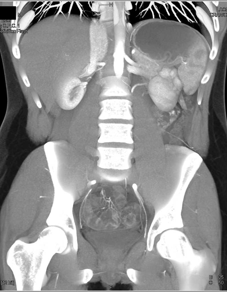 Accessory Hepatic Artery off the SMA - CTisus CT Scan