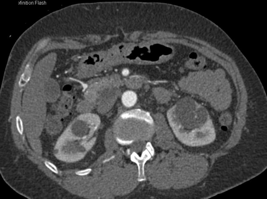 Under 1cm Gastroduodenal Artery (GDA) Aneurysm Seen Well on 3D CTA - CTisus CT Scan