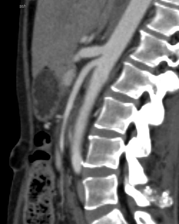 Superior Mesenteric Artery (SMA) Syndrome with Narrowed SMA Angle and Dilated Proximal Duodenum - CTisus CT Scan