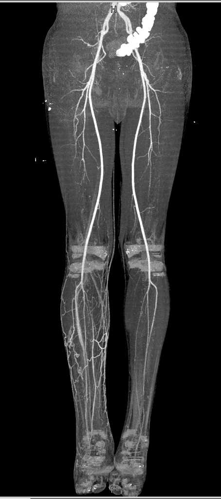 CT Runoff with Venous Collaterals in Right Calf - CTisus CT Scan