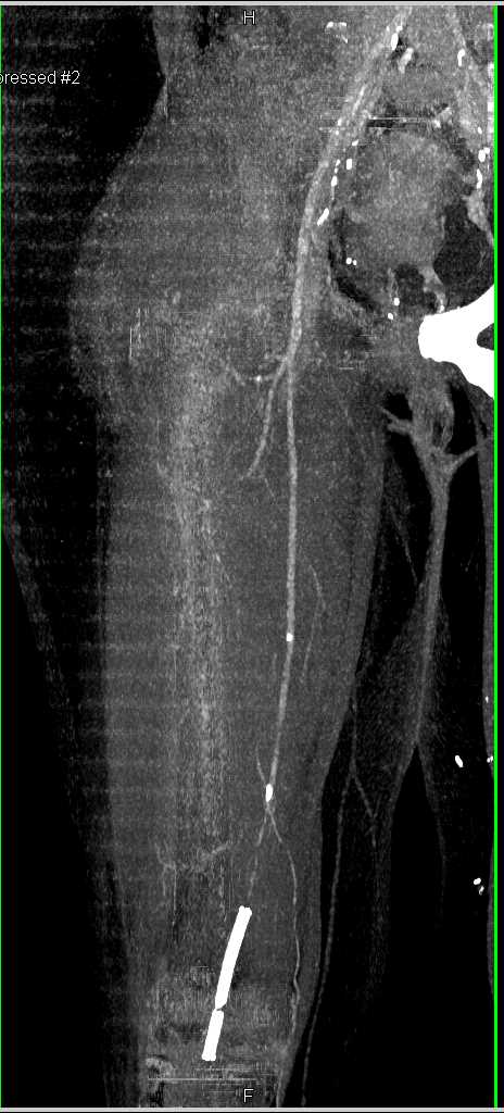 Dual Energy CTA Runoff with Peripheral Vascular Disease (PVD) and Occluded Stent - CTisus CT Scan