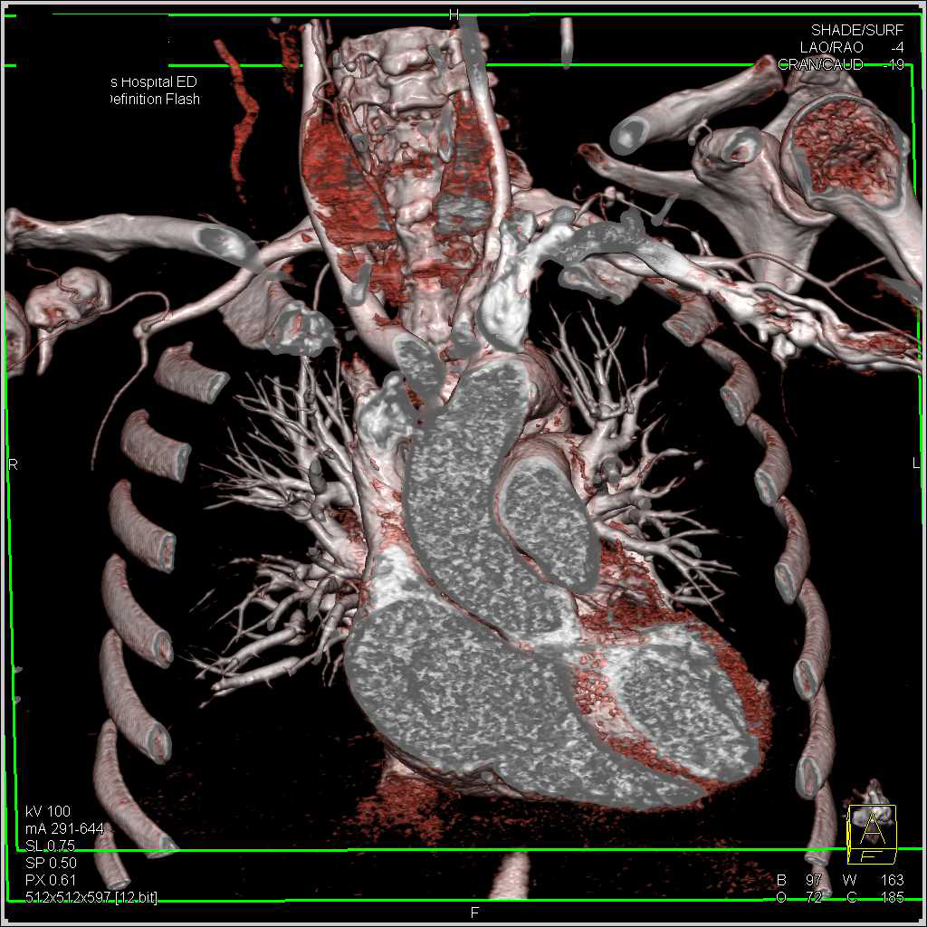 Trauma with Occluded Right Brachial Artery - CTisus CT Scan