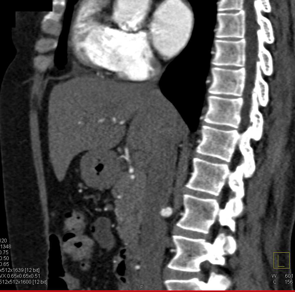 Dissection Celiac Axis and Right Renal Artery - CTisus CT Scan