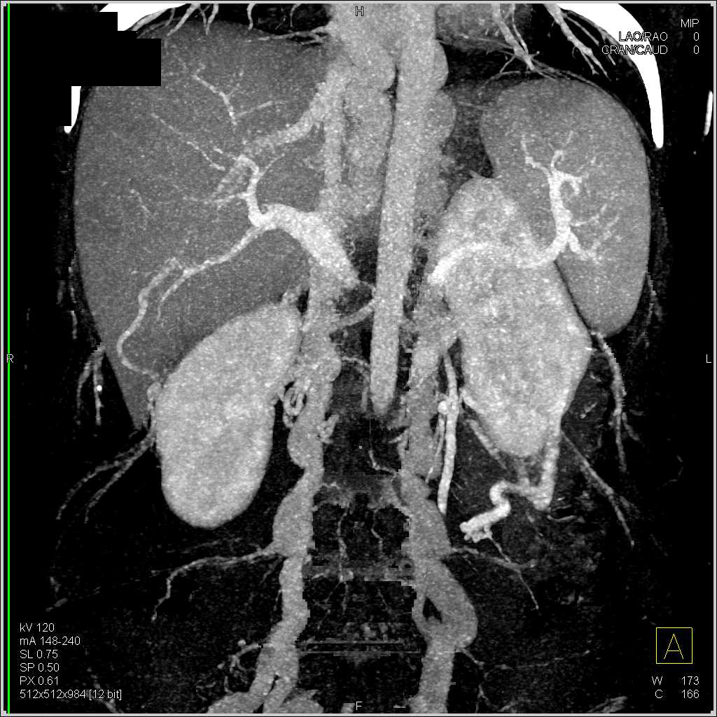 Inferior Vena Cava (IVC) Occlusion with Extensive Collaterals in Paraspinal Region - CTisus CT Scan