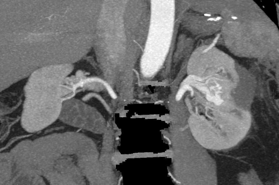 Arteriovenous (AV) Fistulae Left Kidney - CTisus CT Scan