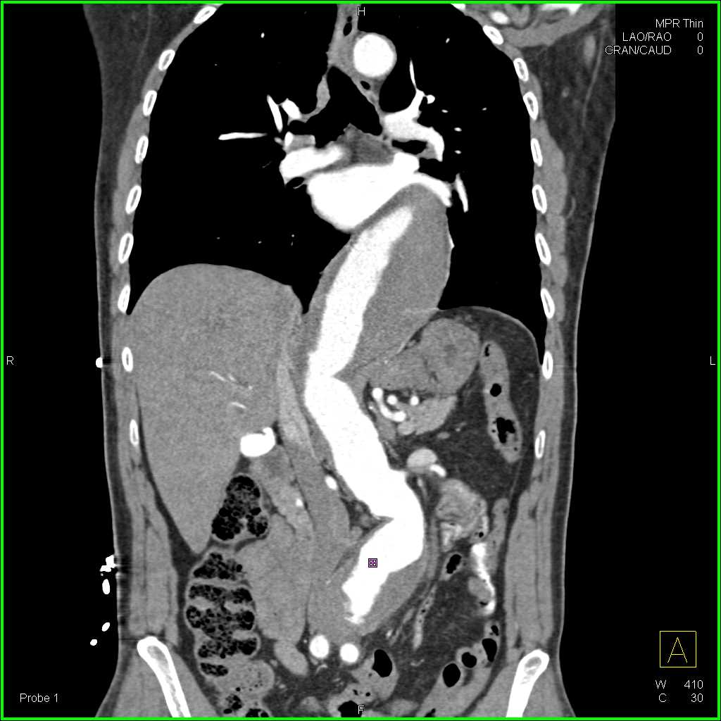 Thoraco-Abdominal Aortic Aneurysm - CTisus CT Scan