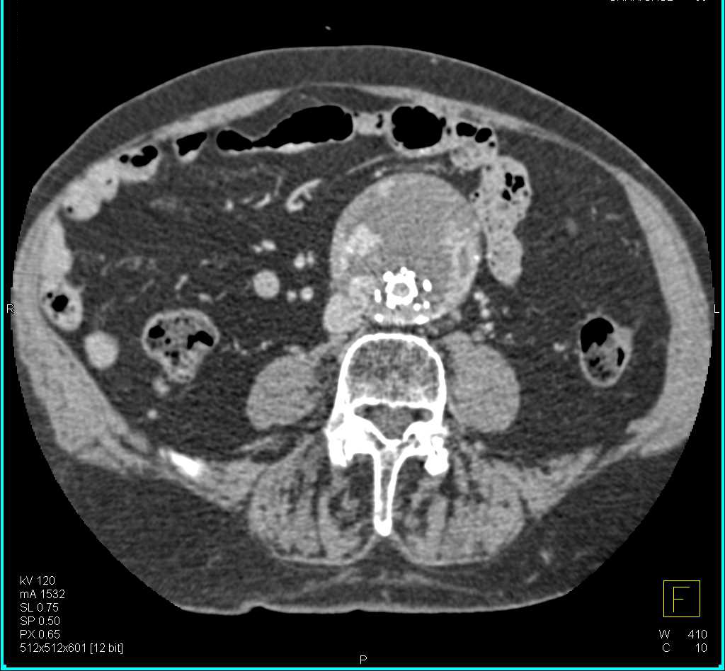 Endovascular Stent with Endoleak and Occluded Left Limb of Graft - CTisus CT Scan