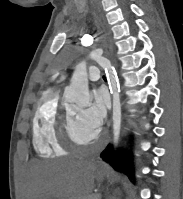 Stent Repair of Coarctation of the Aorta - CTisus CT Scan