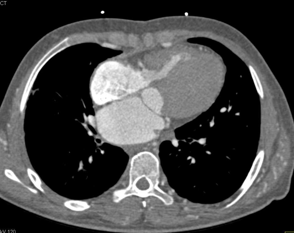 Vasculitis with Small Caliber Descending Aorta - CTisus CT Scan