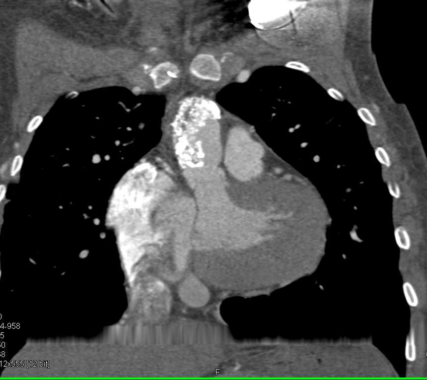 Vasculitis with Small Caliber Descending Aorta - CTisus CT Scan