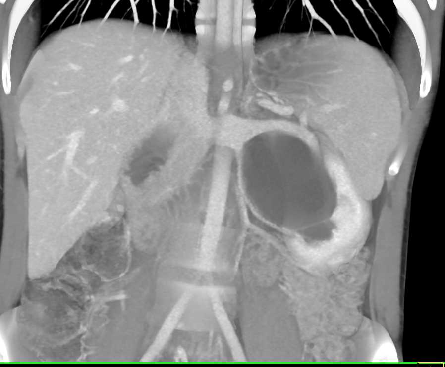 Left Ureteropelvic Junction (UPJ) Obstruction due to Crossing Artery Best Seen on 3D VRT - CTisus CT Scan