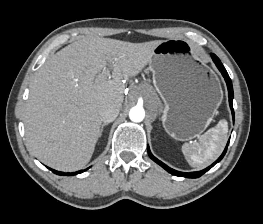 Neurogenic Tumor Encases the SMA - CTisus CT Scan