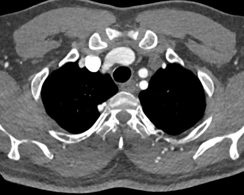 Coarctation of the Aorta with Dilated Internal Mammary Arteries and Other Collaterals - CTisus CT Scan