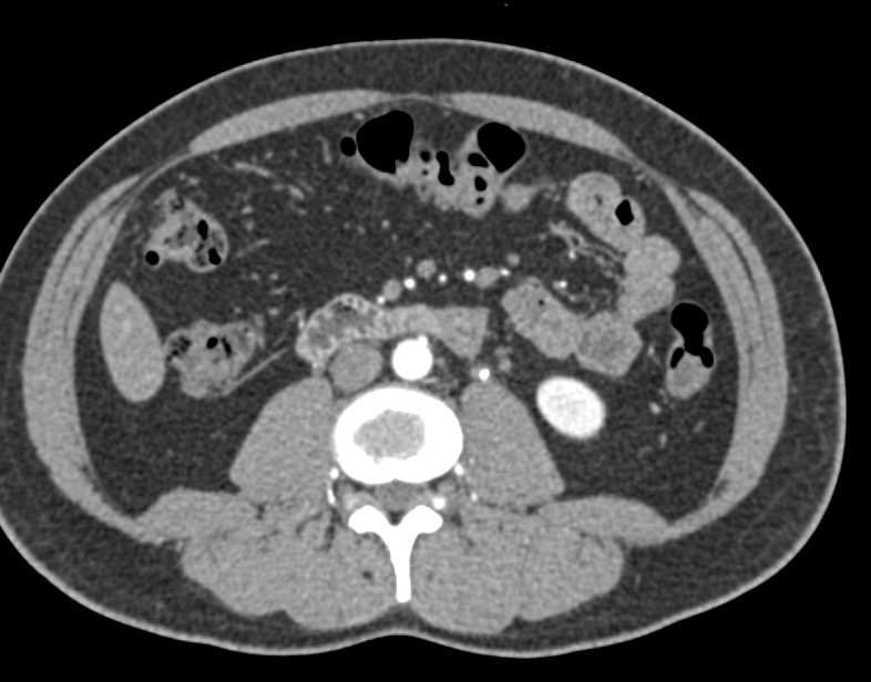 Vascular Map for Preoperative Planning - CTisus CT Scan