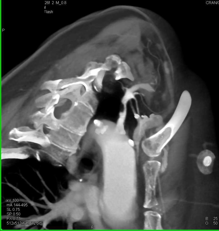 Plaque with Stenosis Left Subclavian Artery - CTisus CT Scan