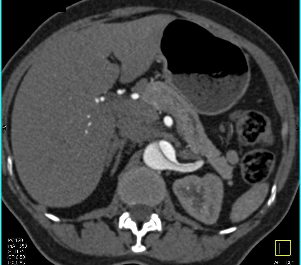 Classic Type B Dissection - CTisus CT Scan