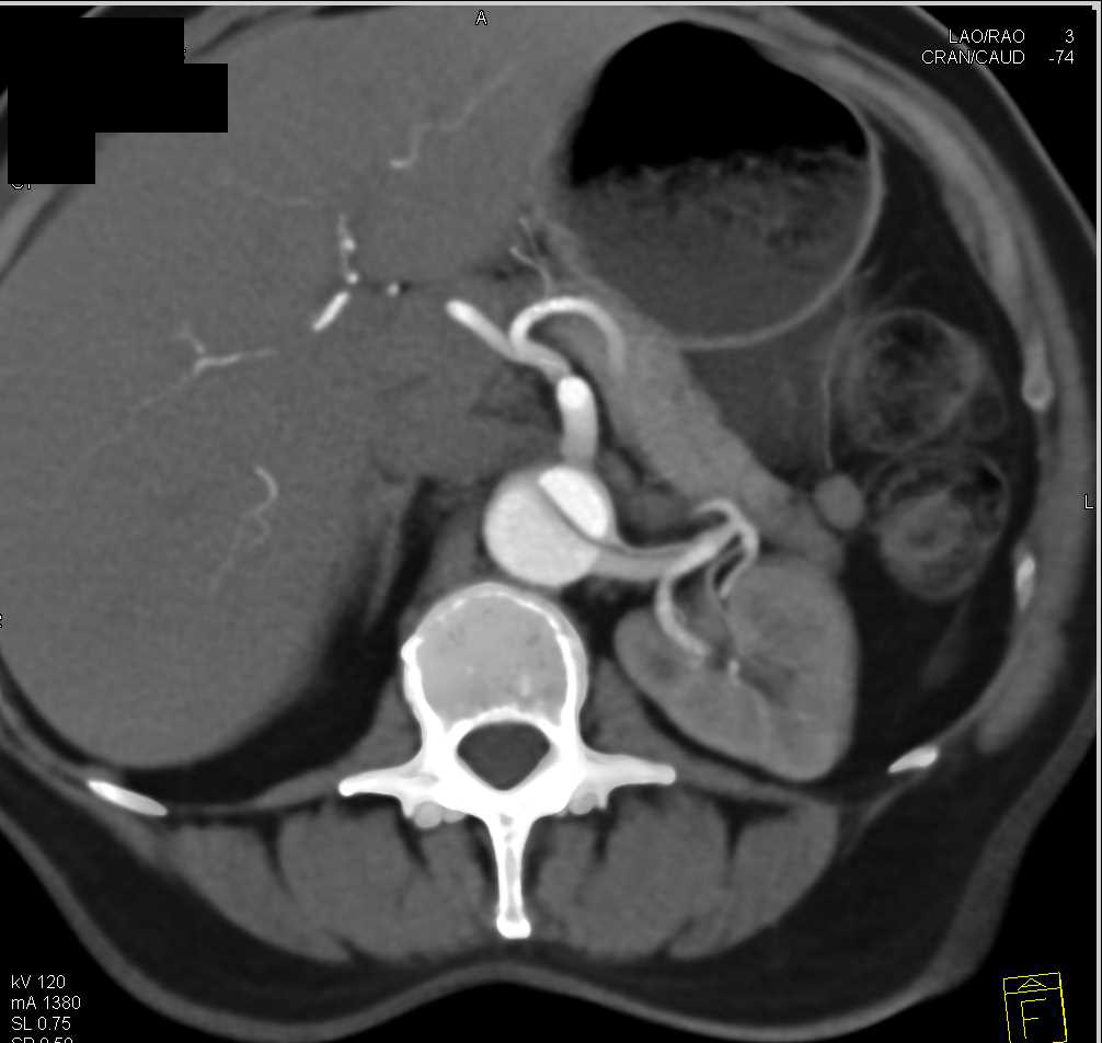 Classic Type B Dissection Extends into Left Renal Artery - CTisus CT Scan