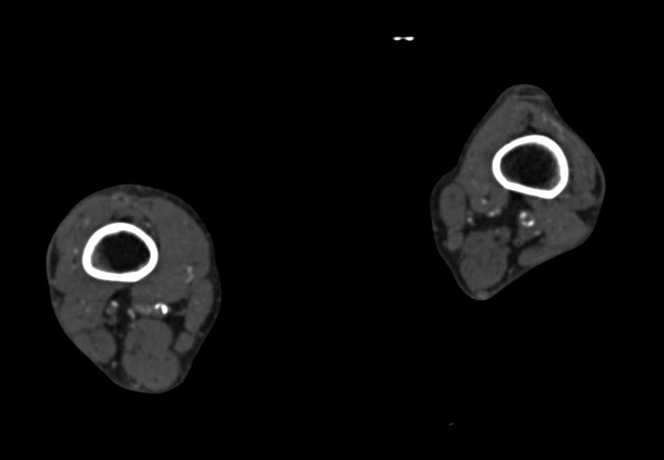 CTA Runoff with Right Superficial Femoral Artery (SFA) Occlusion and Extensive Vascular Disease - CTisus CT Scan