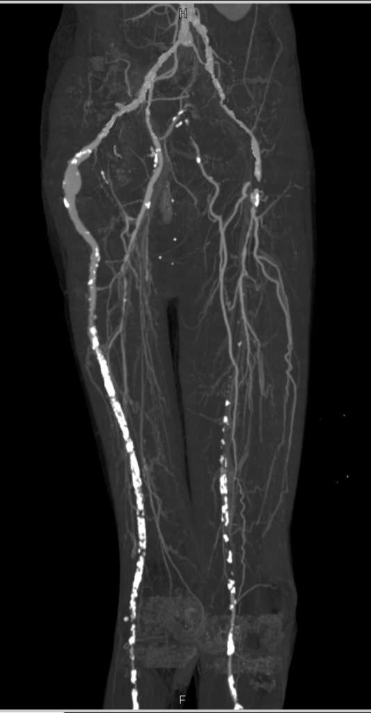 CTA Runoff with Right SFA Occlusion and Extensive Vascular Disease ...