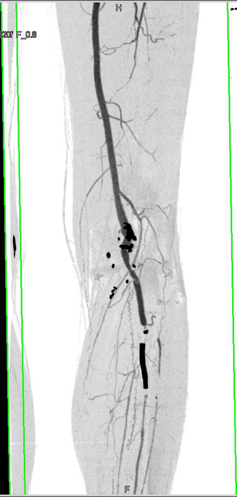 CTA with Occluded Stent in Left Calf - CTisus CT Scan