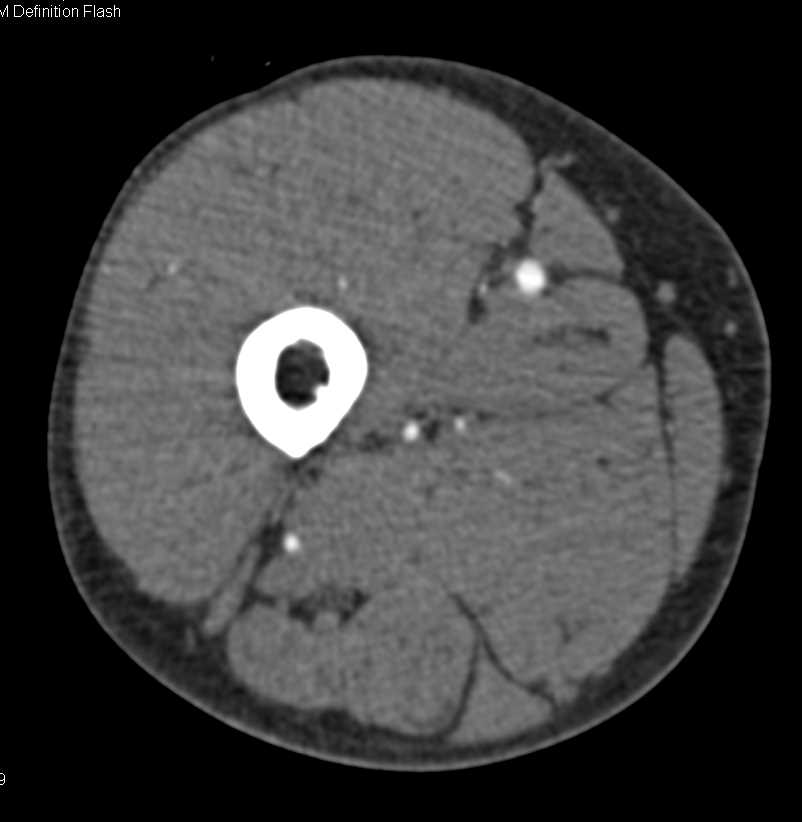 CTA with Occluded Stent in Left Calf and Popliteal Artery Aneurysm - CTisus CT Scan