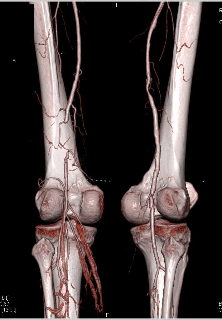 Dual Energy Runoff with Left Superficial Femoral Artery (SFA) Occlusion by Thrombus - CTisus CT Scan