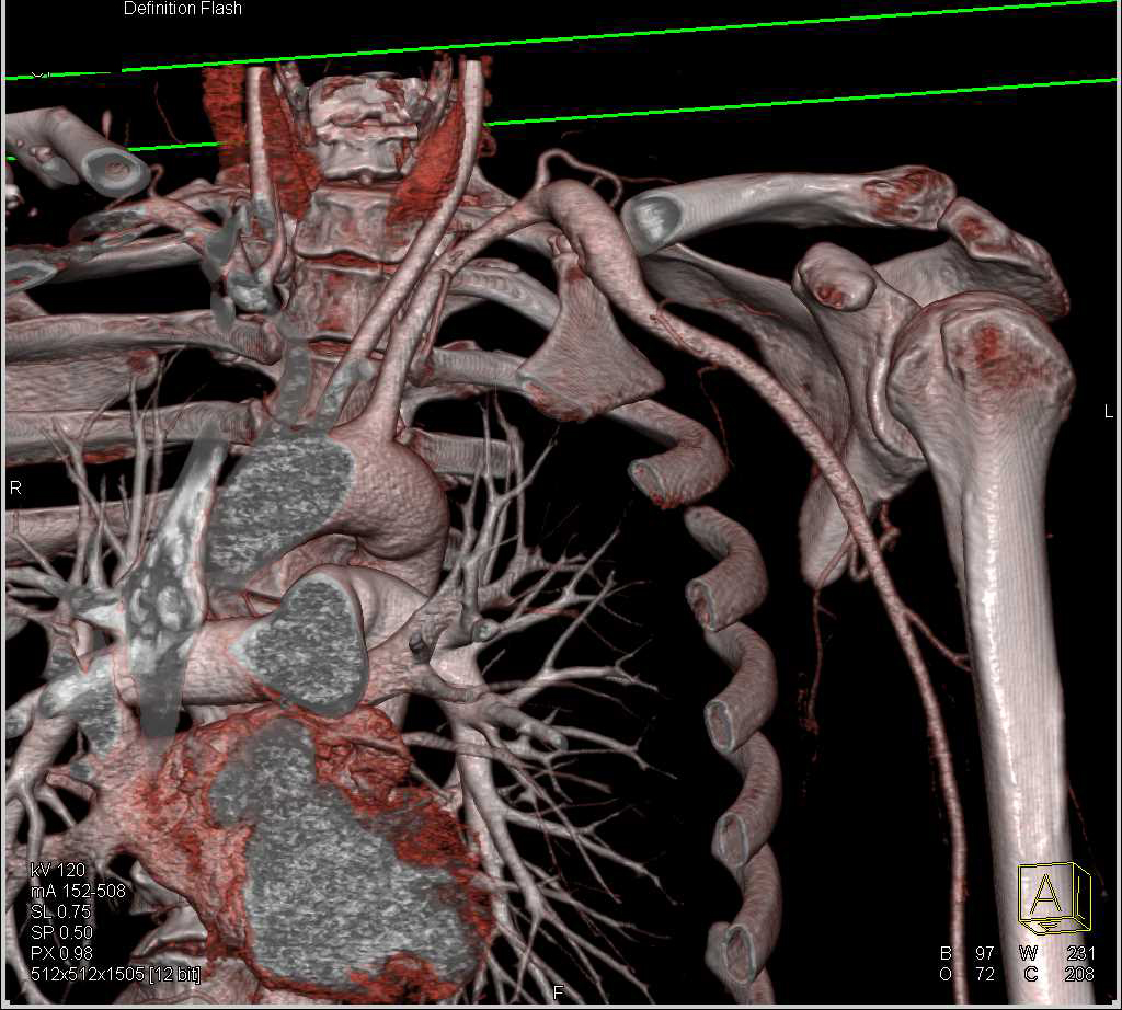 Left Subclavian Artery Aneurysm - Vascular Case Studies - CTisus CT