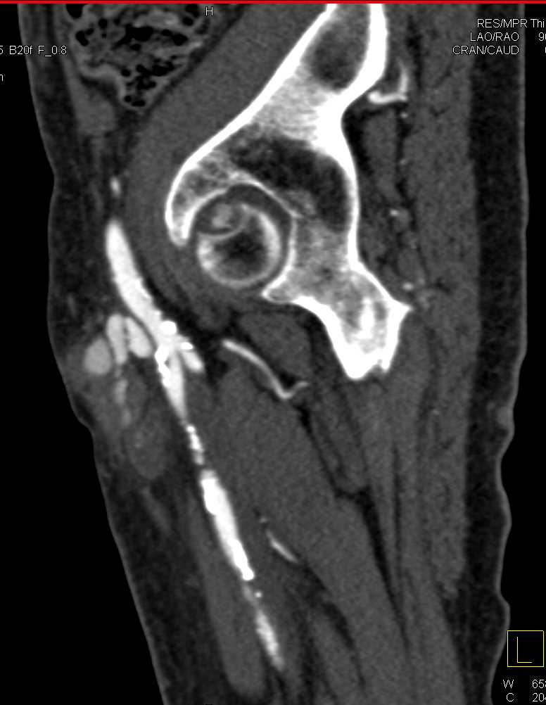 Pseudo-Aneurysm of the Femoral Artery - CTisus CT Scan