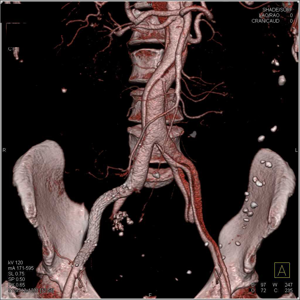 Type B Dissection with Stent - CTisus CT Scan