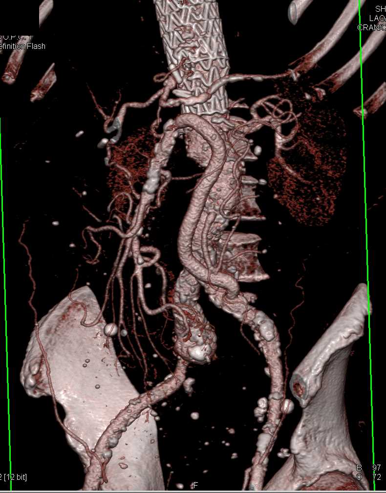 Aortic Aneurysm With Stent and Grafts - CTisus CT Scan