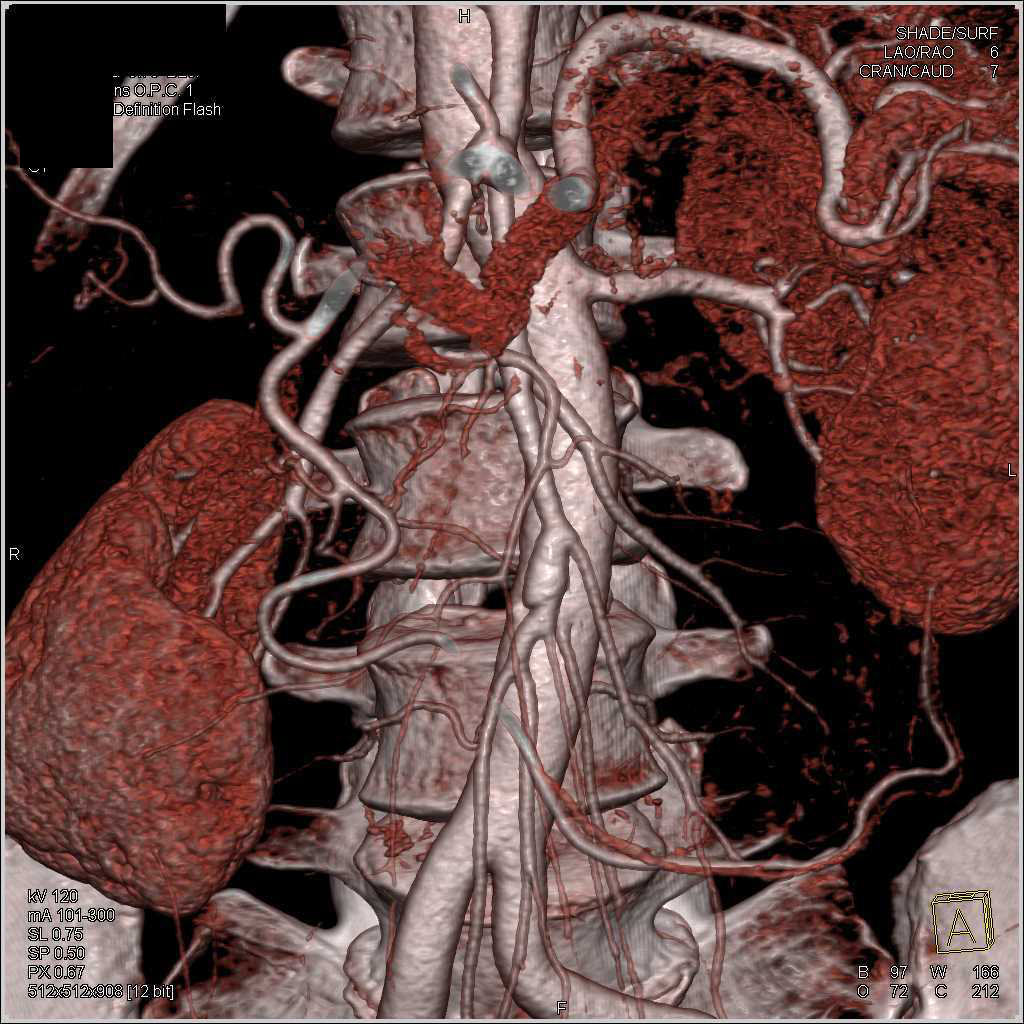 SMA Aneurysm on a CTA - Vascular Case Studies - CTisus CT Scanning