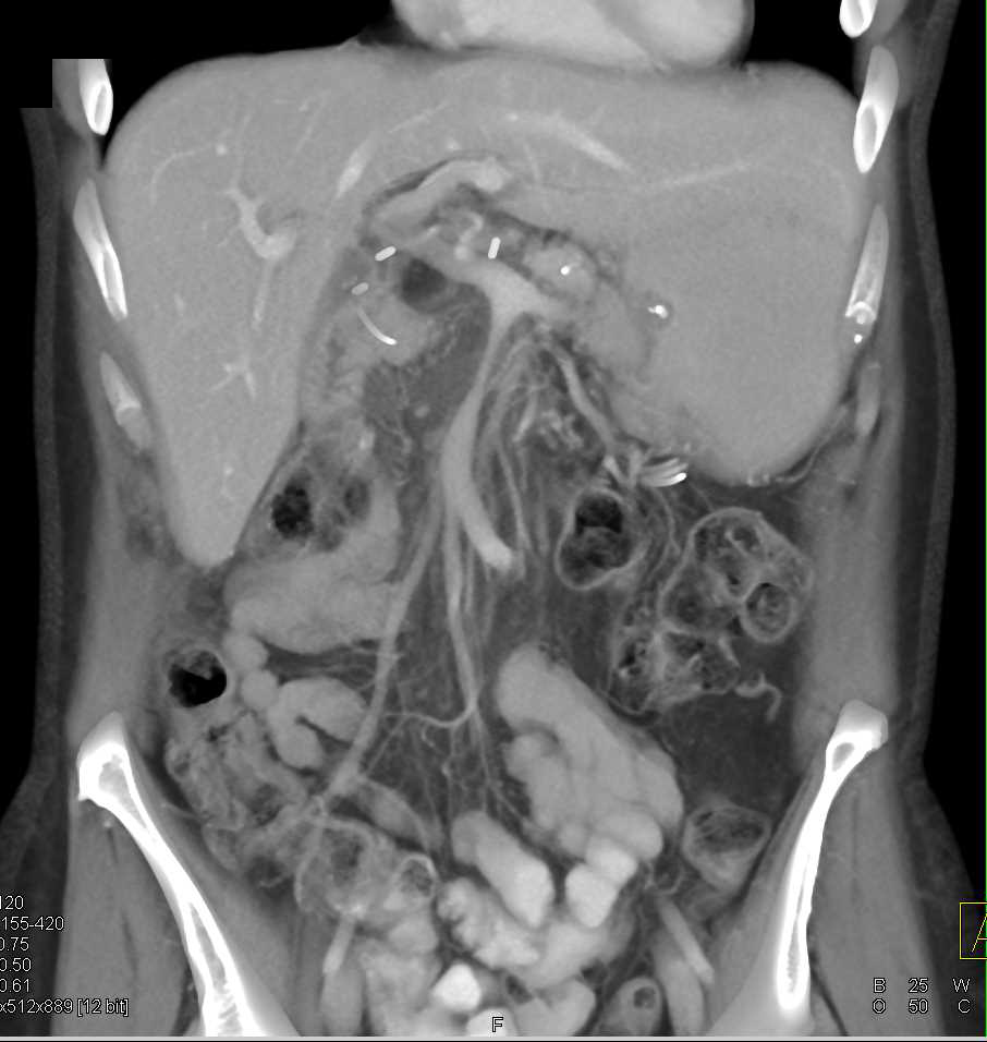 Superior Mesenteric Vein (SMV) Encased by Tumor - CTisus CT Scan