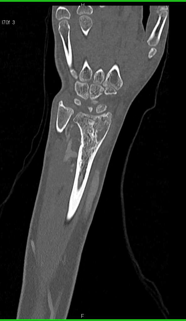 Arteriovenous (AV) Shunting Beneath Elbow with Perfusion Changes - CTisus CT Scan