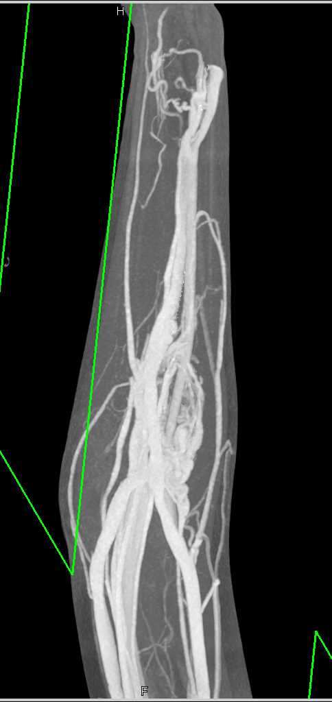 Arteriovenous (AV) Shunting at Level of the Elbow - CTisus CT Scan