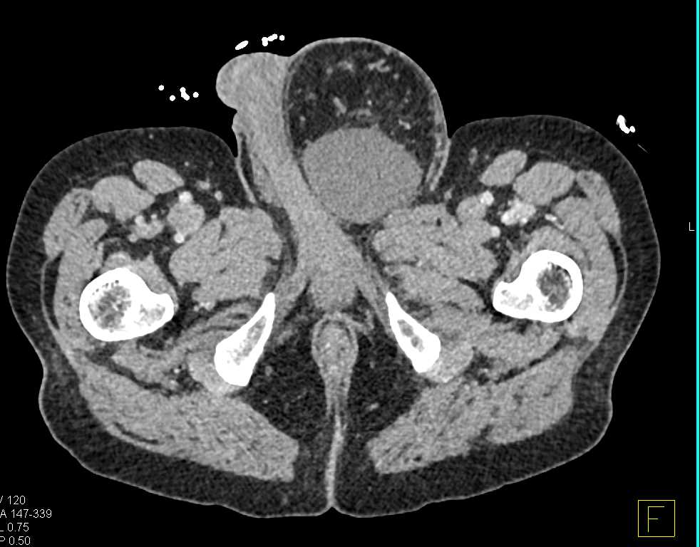 Inferior Vena Cava (IVC) Occlusion with Multiple Collaterals - CTisus CT Scan