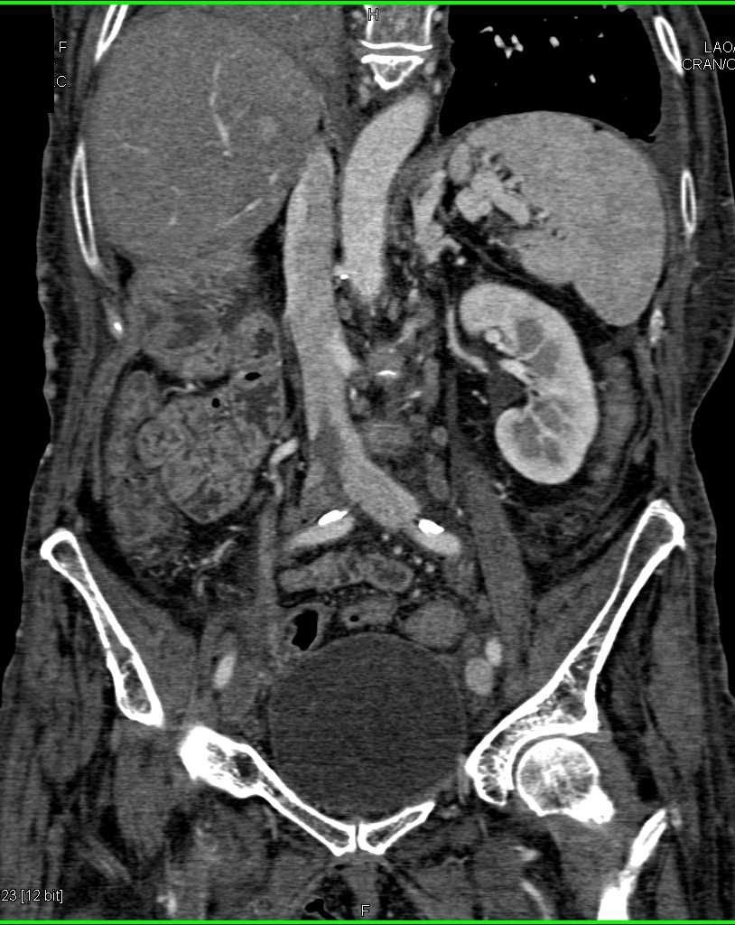 Inferior Vena Cava (IVC) Clot Extending into the Iliac and Femoral Veins Especially on the Right Side - CTisus CT Scan