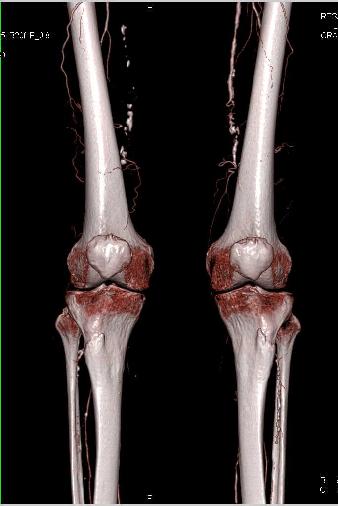 CTA Runoff with Occluded Right Iliac Artery and Peripheral Vascular Disease (PVD) - CTisus CT Scan