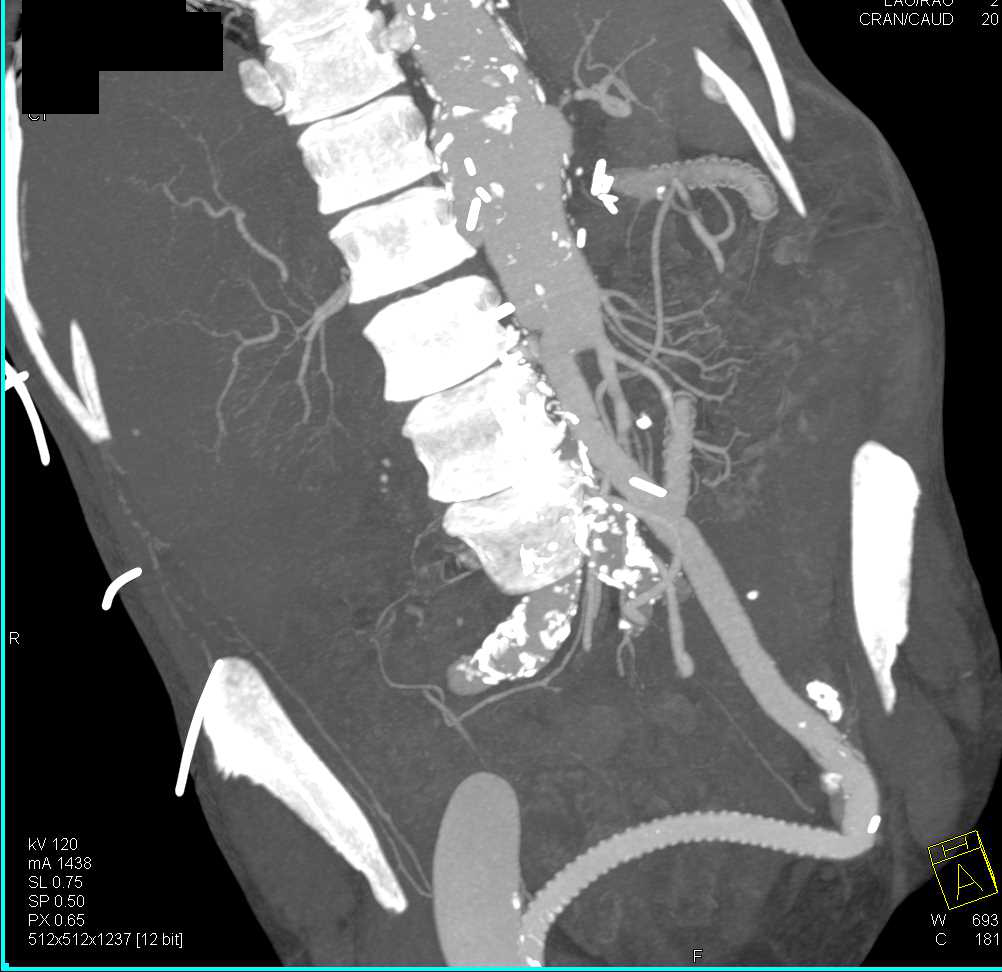 Pseudoaneurysm  Ascending Aorta s/p Repair as well as Fem-Fem Bypass - CTisus CT Scan