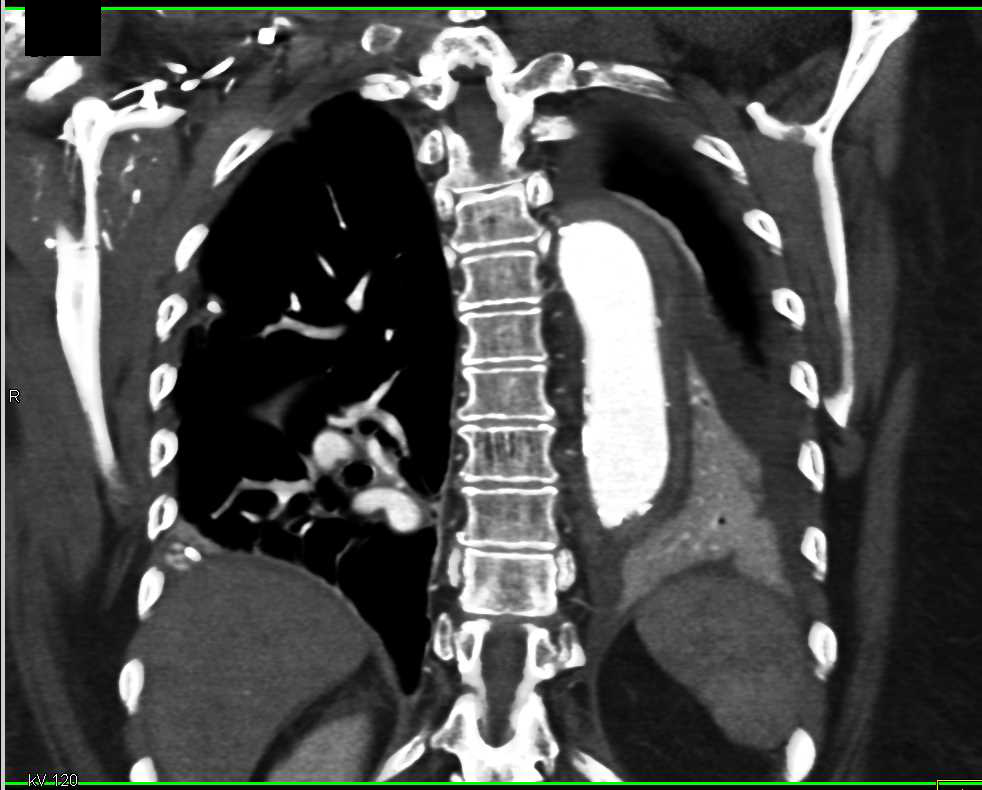 Type A Dissection with Repair and Air in Anterior Mediastinum - CTisus CT Scan