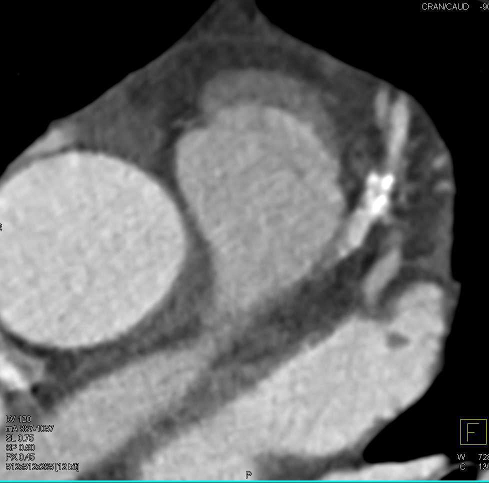 Ulceration of Thoracic Aorta and Coronary Artery Disease - CTisus CT Scan