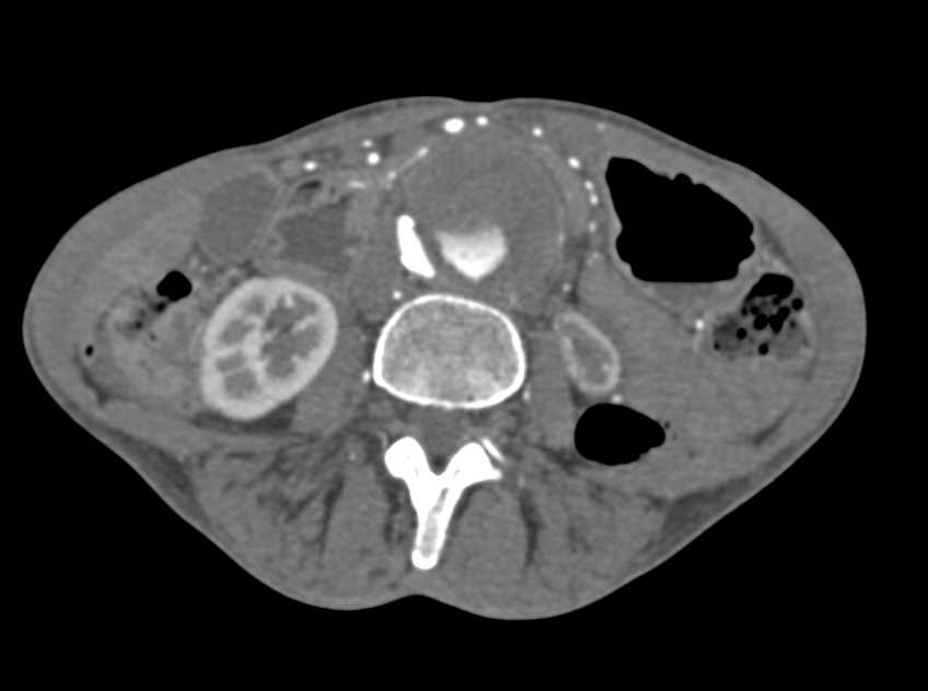 Aortic Dissection with No Flow to Right Iliac Arteries - CTisus CT Scan