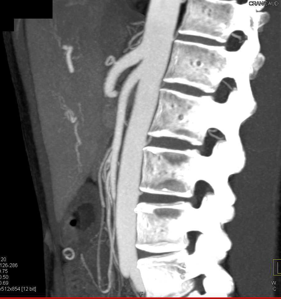 Superior Mesenteric Artery (SMA) Syndrome with Incidental Pericardial Cyst - CTisus CT Scan