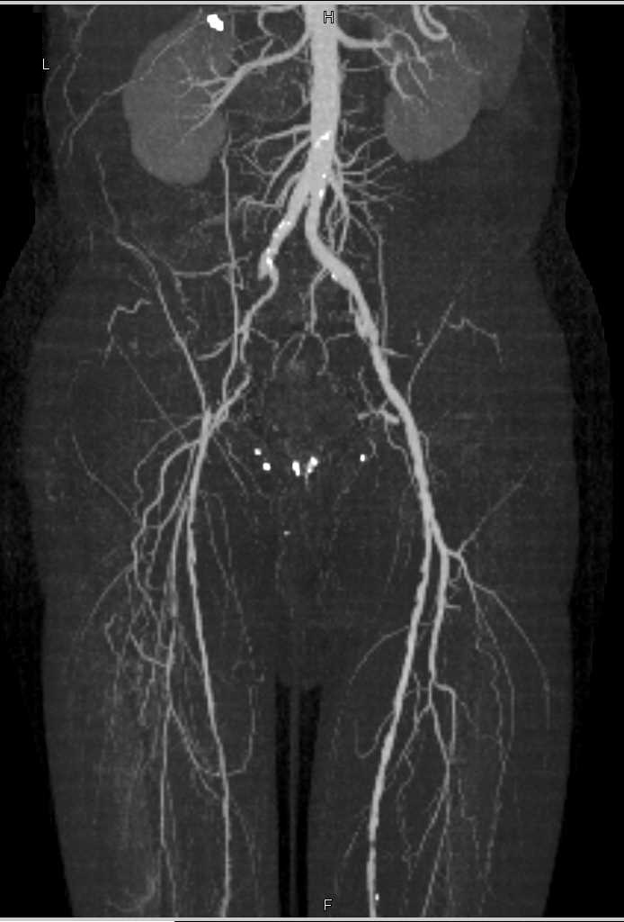 CTA Runoff with Occluded Right Superficial Femoral Artery (SFA) and