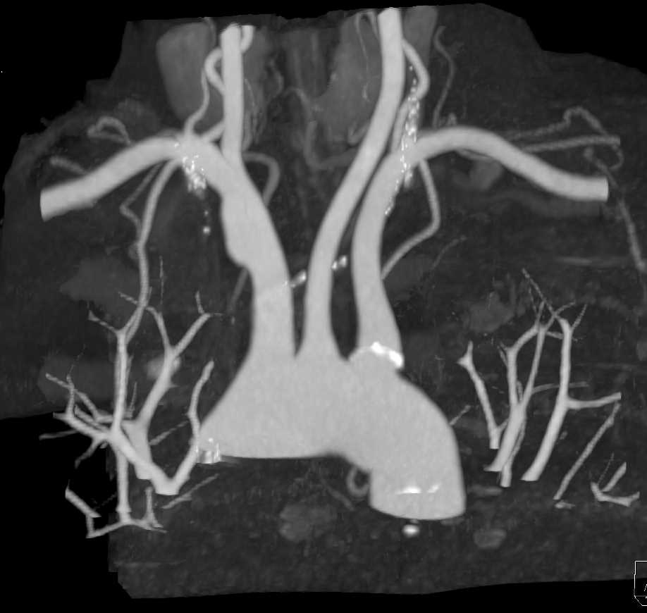 Vascular Mapping with Stenosis at Sight of Grafting - CTisus CT Scan