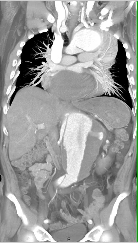 Thoracic and Abdominal Aortic Aneurysm - CTisus CT Scan