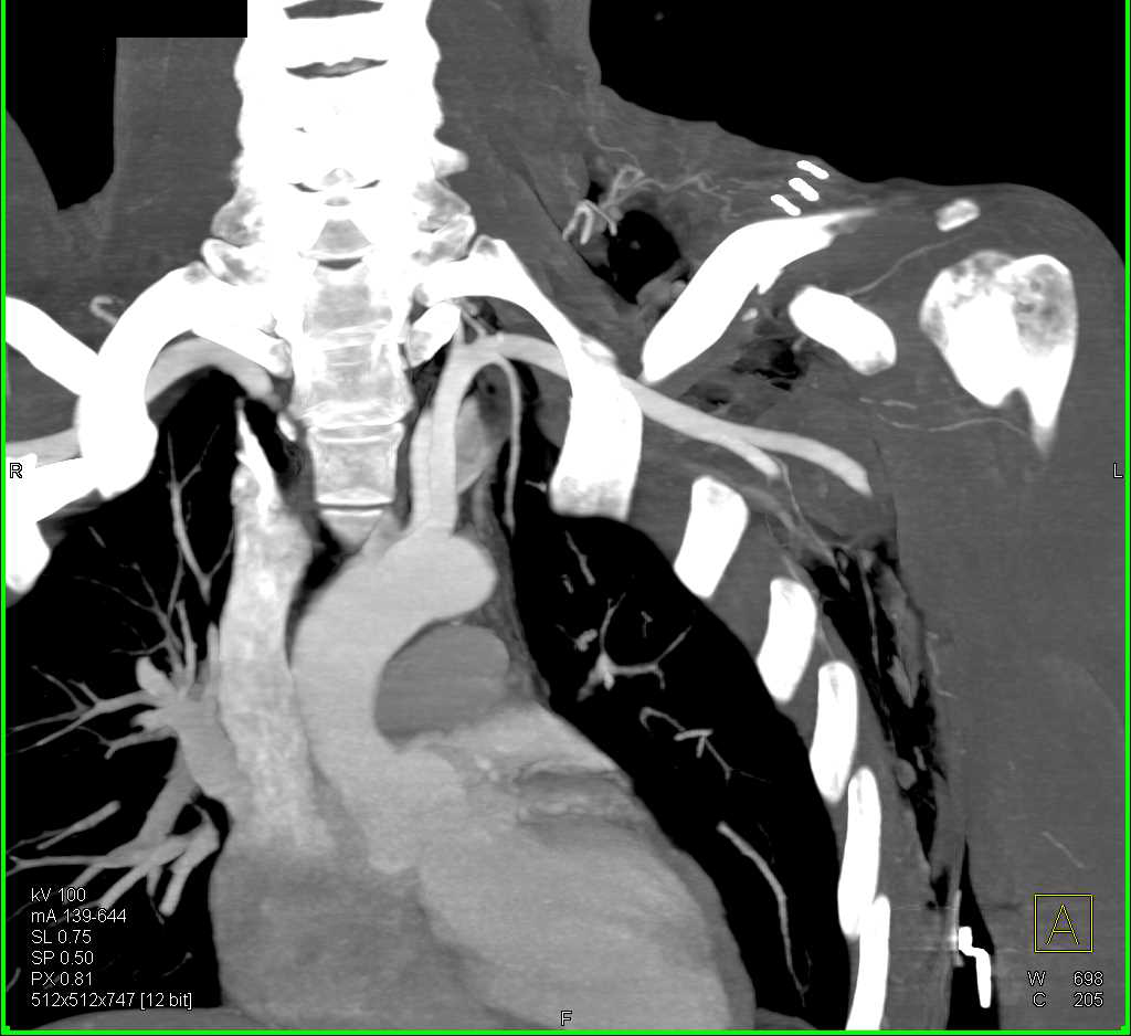 CTA with Patent Left Axillary to Brachial Artery - CTisus CT Scan