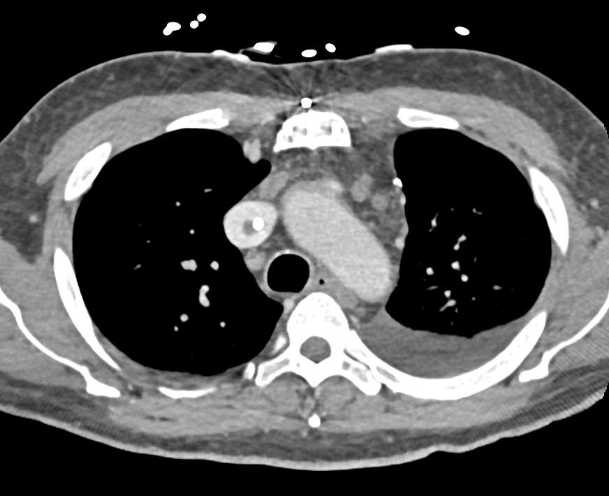 Multiple Clots Including Superior Vena Cava (SVC), Left Atrium and Right Femoral Vein - CTisus CT Scan